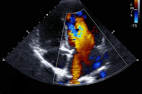 what does a normal echocardiogram look like.